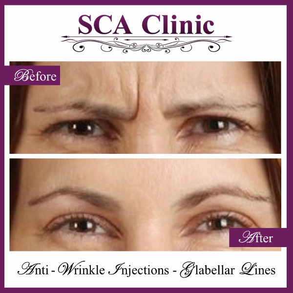 Anti-Wrinkle Injections - Glabellar Lines
